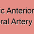 Complete Blockage Anterior Inferior Temporal Artery Stroke