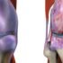 Contraindications and Complication of Knee Arthroplasty