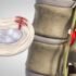 L1 and L2 Disc Herniation – Causes, Symptoms, Treatment