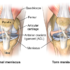 Medial Meniscus Tear – Causes, Symptoms, Treatment