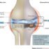 Treatment Of Knee Joints Osteoarthritis