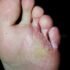 Tinea Pedis Causes, Symptoms, Treatment