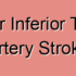 Perimesencephalic Subarachnoid Hemorrhagic Anterior Inferior Temporal Artery Stroke