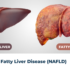 Fatty Changes in Liver; Causes, Symptoms, Treatment