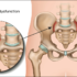 Sacroiliitis – Causes, Symptoms, Diagnosis, Treatment