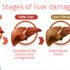 Fatty Liver; Causes, Symptoms, Diagnosis, Treatment