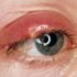Blepharitis Symptoms, Diagnosis, Treatment