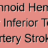 Thrombotic Anterior Inferior Temporal Artery Stroke