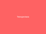 Telangiectasia