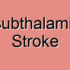 Fibrillation-Induced Posterior Inferior Cerebellar Artery Stroke