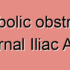Degenerative Stenosis of External Iliac Artery